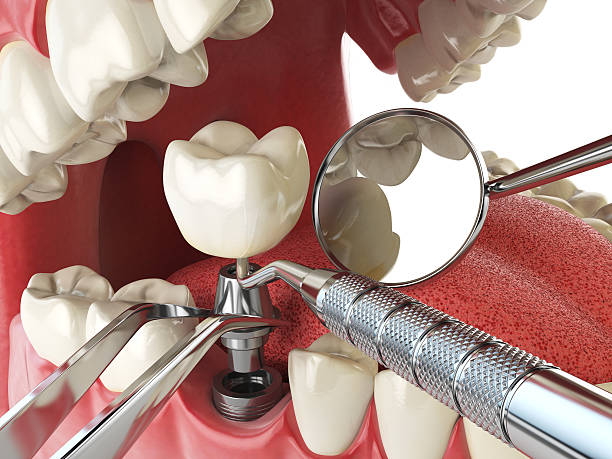 Best Emergency Wisdom Teeth Removal in Apache, OK
